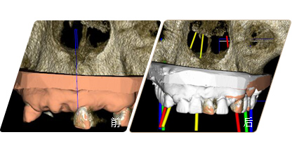 數字化種植牙設計軟件前后對比